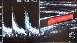 頸動脈超音波検査（頸動脈エコー）・血流測定