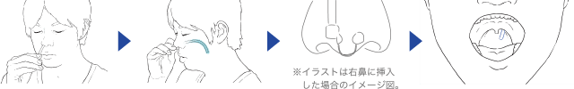 睡眠時無呼吸症候群の新しい治療法 ナステント 小杉ファミリークリニック