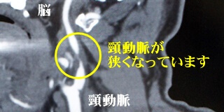 頸動脈が狭くなっています