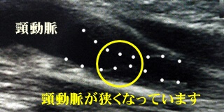 頸動脈が狭くなっています